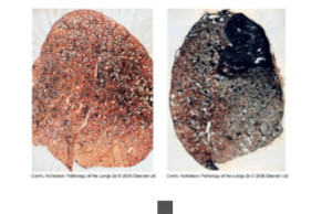 Beryllious Lungs